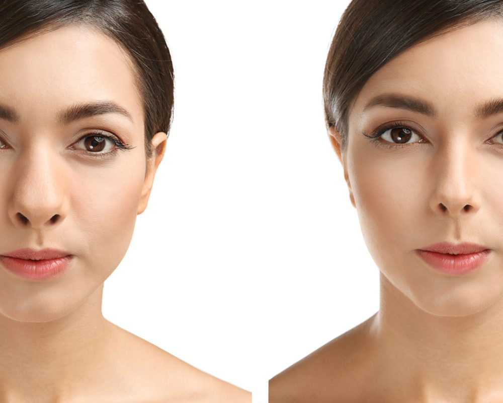Young woman before and after rhinoplasty on white background. Plastic surgery concept