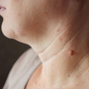 Close-up of a mole on a woman's neck.