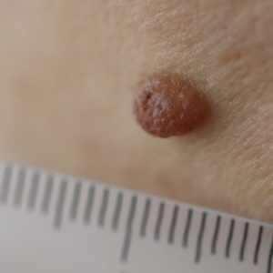 Doctor measuring size of patients pigmented nevus with ruler in clinic closeup. Diagnosis of skin tumors concept